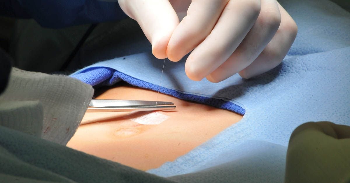 Hernia Umbilical Centro de la Hernia de Tijuana
