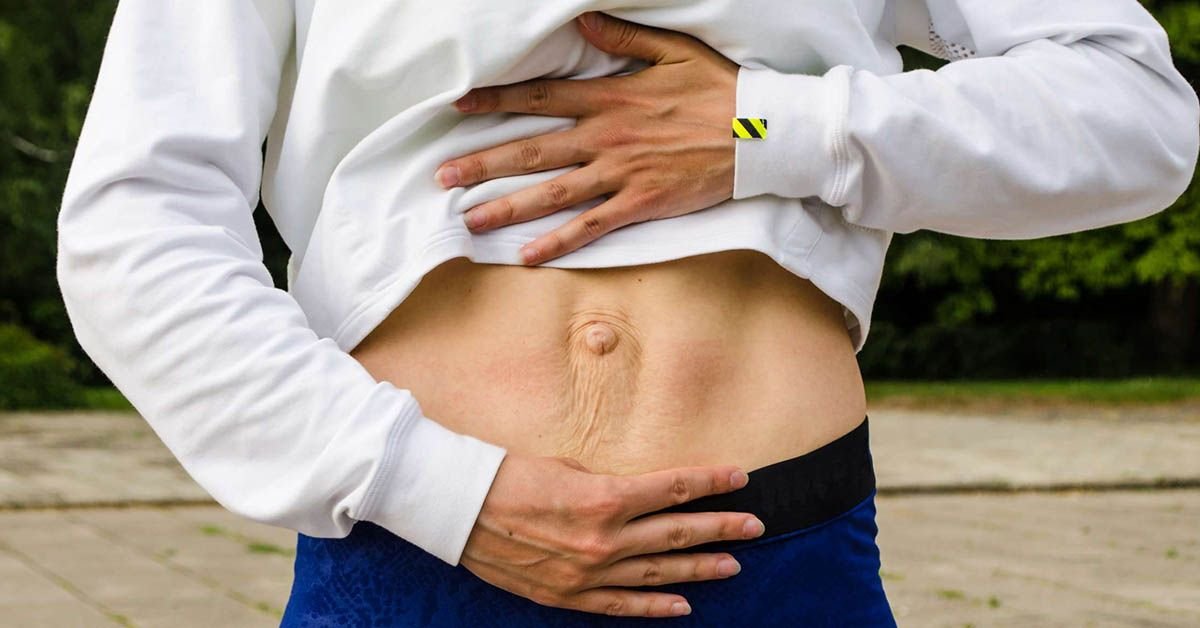 Diástasis de recto Centro de la Hernia de Tijuana