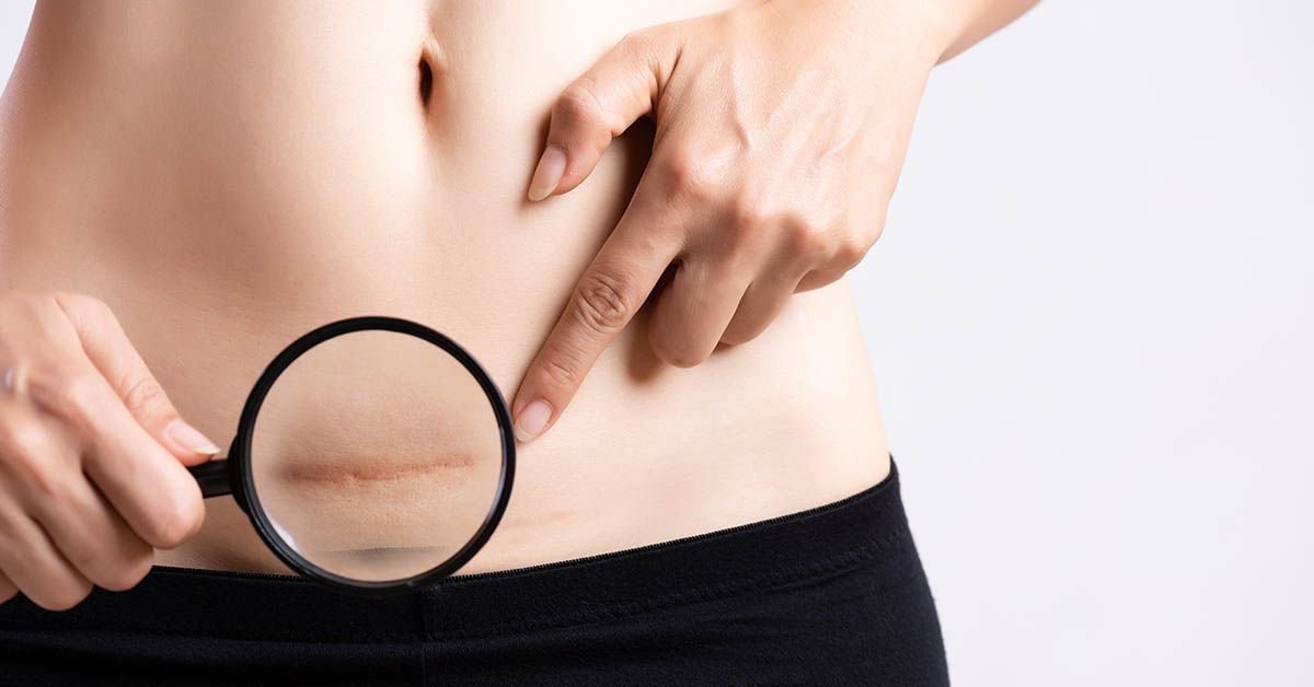 Hernia Incisional Centro de la Hernia de Tijuana